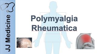 RHEUMATOID ARTHRITIS DIAGNOSIS CRITERIATREATMENT NURSING MANAGEMENT RHEUMATOLOGY MEDICINE LECTURES [upl. by Bucher]