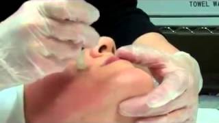 Dermapen Micro Needling Treatment [upl. by Eecats]