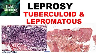 LEPROSY etiopathogenesis classification Tuberculoid amp lepromatous leprosy [upl. by Etra100]