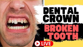 Tooth Crown Procedure  Front Tooth Crowns for Broken Teeth LIVE [upl. by Yelad]