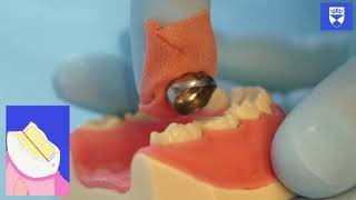 Stainless Steel Crown Technique for a Primary Molar Tooth [upl. by Luke]