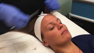 Dermaplaning and Chemical Peel Demonstration amp Results [upl. by Cyn]