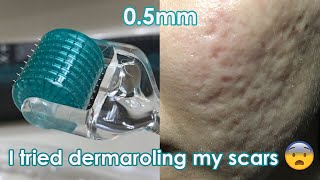 I tried dermarolling my ACNE SCARS  Demo  Review [upl. by Adnerb]