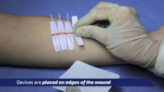 DermaClip Basic Overview a NonInvasive Wound Closure Device [upl. by Arenahs259]