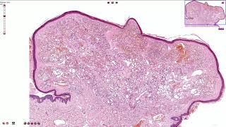 Capillary Hemangioma  Skin Histopathology [upl. by Whitehurst49]