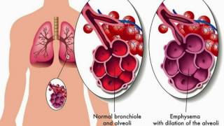 Bronchiolitis Causes Classification Symptoms Diagnosis and Treatment [upl. by Spohr]