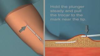 Jadelle insertion and removal Tutorial [upl. by Errick227]