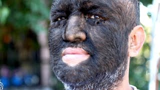 Meet the Worlds Hairiest Man [upl. by Cathleen479]