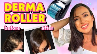 DIY TREATMENT DERMA ROLLER FOR HAIR LOSS  MIRACLE SECRET CURE [upl. by Oirretno438]