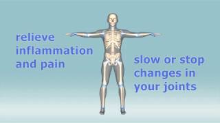 Rheumatoid Arthritis  autoimmune disorder  Pathophysiology risk factors treatment [upl. by Germain471]