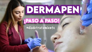 DERMAPEN  TRATAMIENTO DE MICRONEEDLING  Ximena Ramaya [upl. by Ornie]