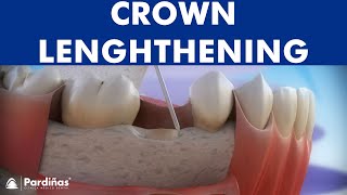 Dental crown lengthening © [upl. by Bink]