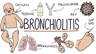 PART I  Pneumonia Overview Lobar and Bronchopneumonia [upl. by Osnola]